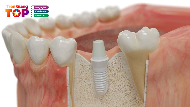 Chi-phi-trong-rang-implant-tai-nha-khoa-dong-nam-tiengiangtoplist